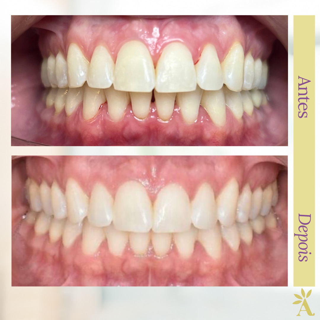 Evolução Ortodôntica (antes e depois)